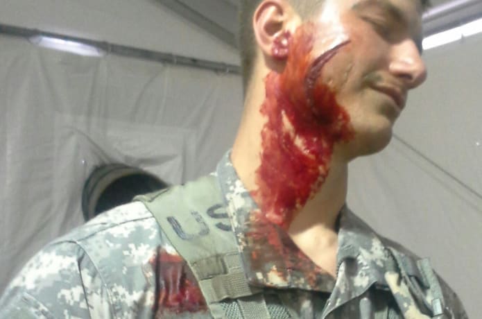 Shrapnel wounds.